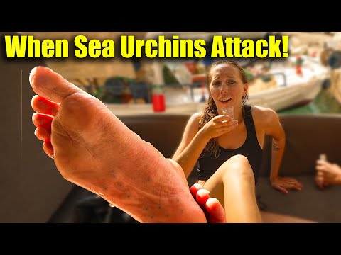 Gruesome Sea Urchin Attack - Needed a Nurse!